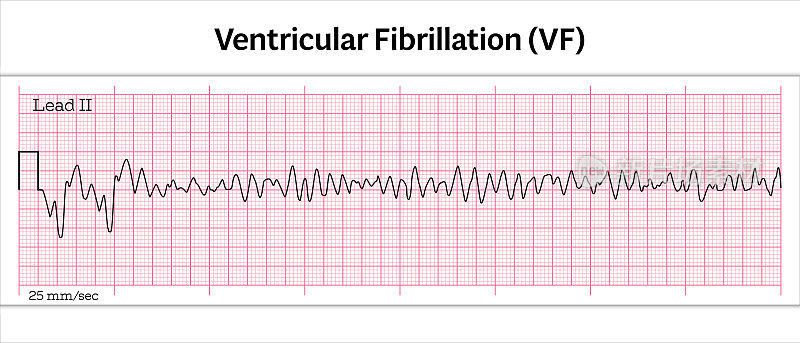 心电图室颤(VF) - 8秒心电图纸